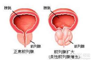 三大症状判断前列腺是否增生